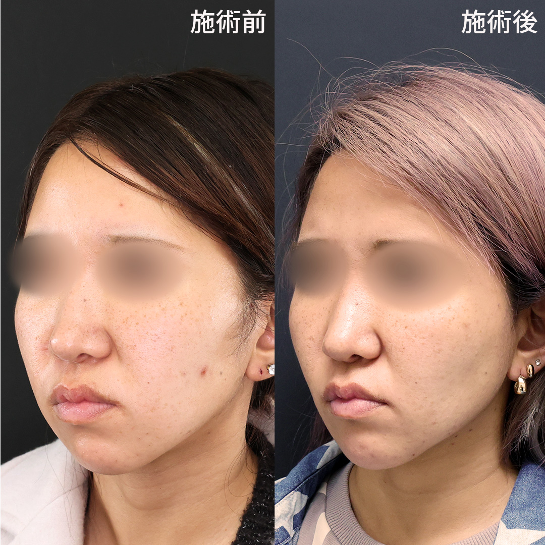 TAC式 ツヤ肌コラーゲンリフト®/ジョールファット除去/Lラインファット除去（エラ下脂肪除去）の症例写真 施術前後 