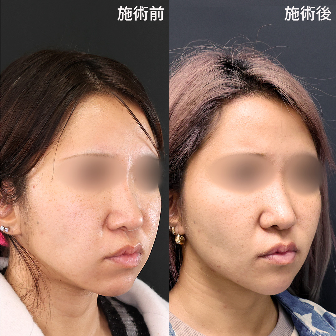 TAC式 ツヤ肌コラーゲンリフト®/ジョールファット除去/Lラインファット除去（エラ下脂肪除去）の症例写真 施術前後 