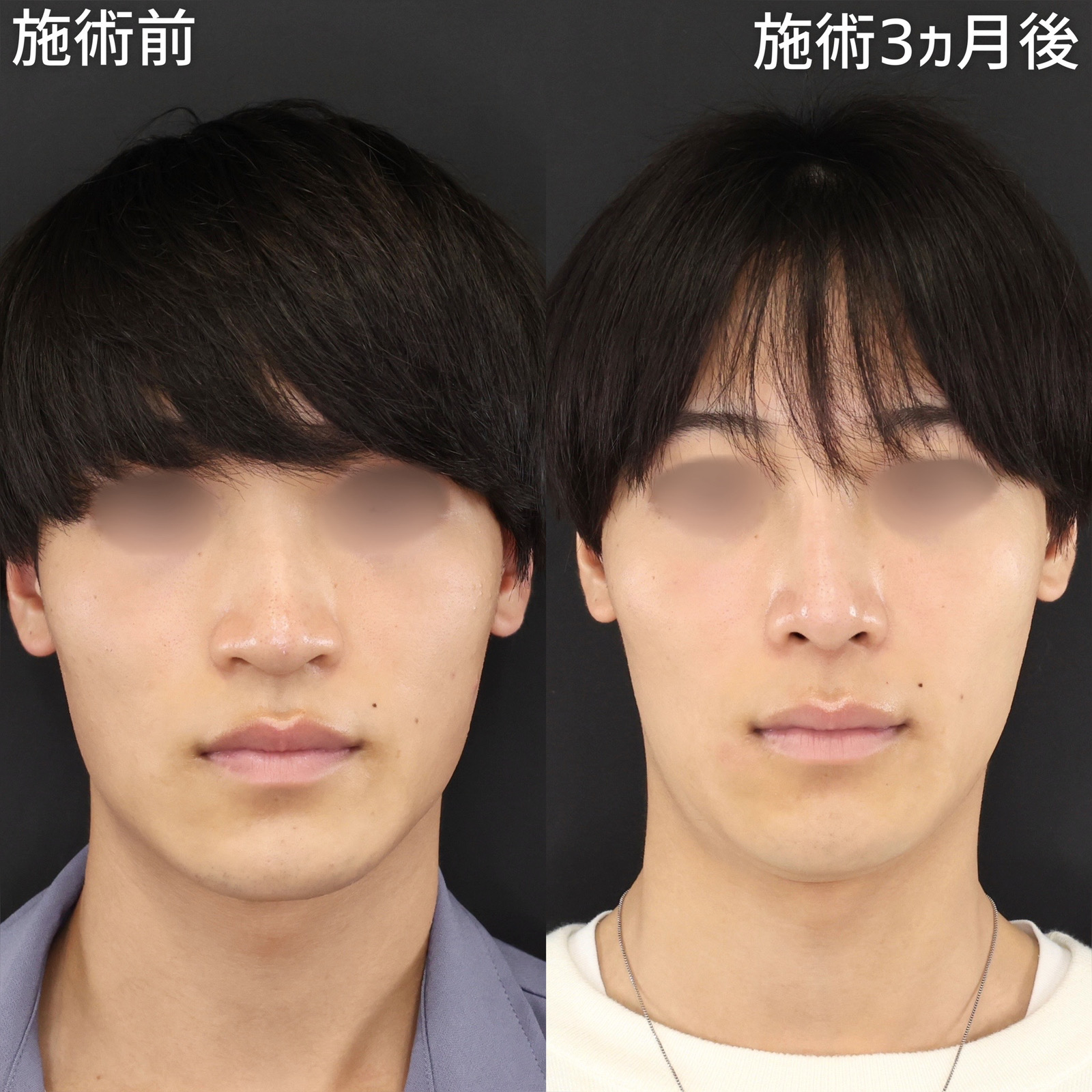 【鼻尖形成】鼻中隔延長なしで下に垂れた鼻を上向きに