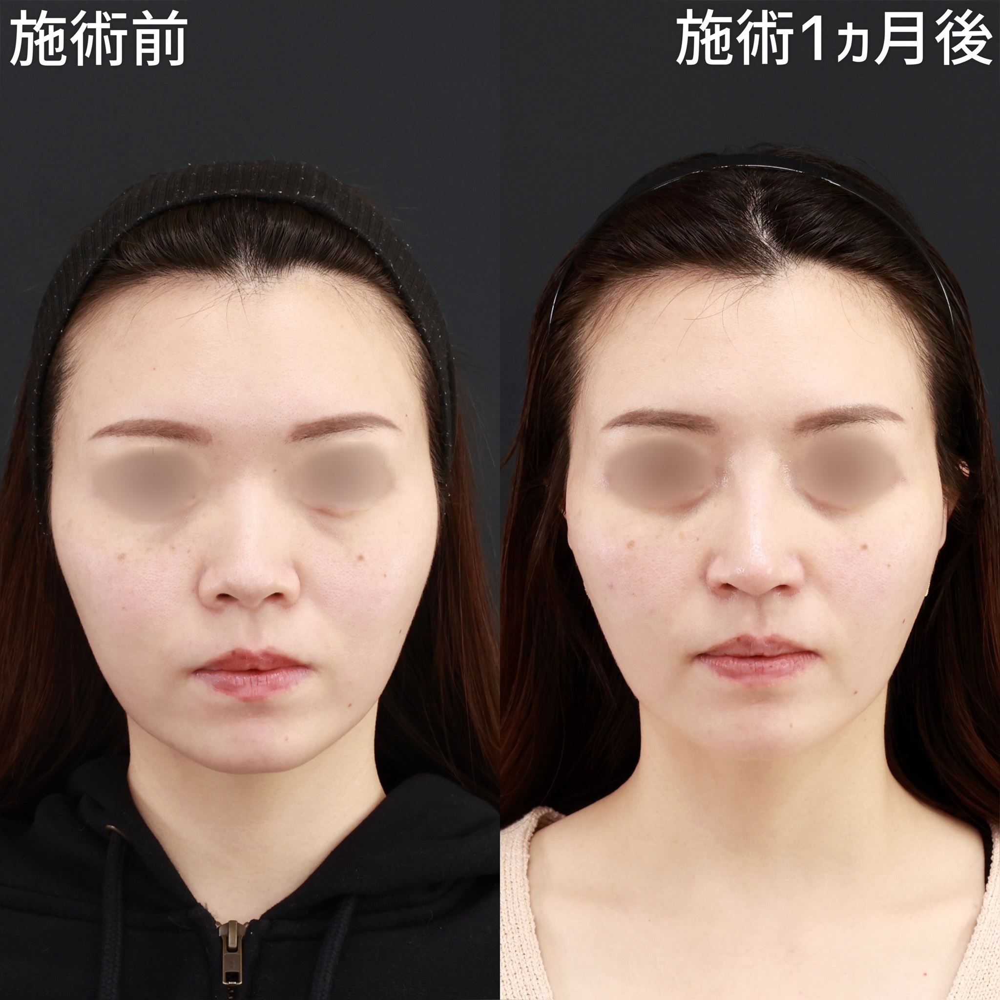 ジョールファット除去/隆鼻術（プロテーゼ・自家組織）/メーラーファット除去の症例写真 施術前後 