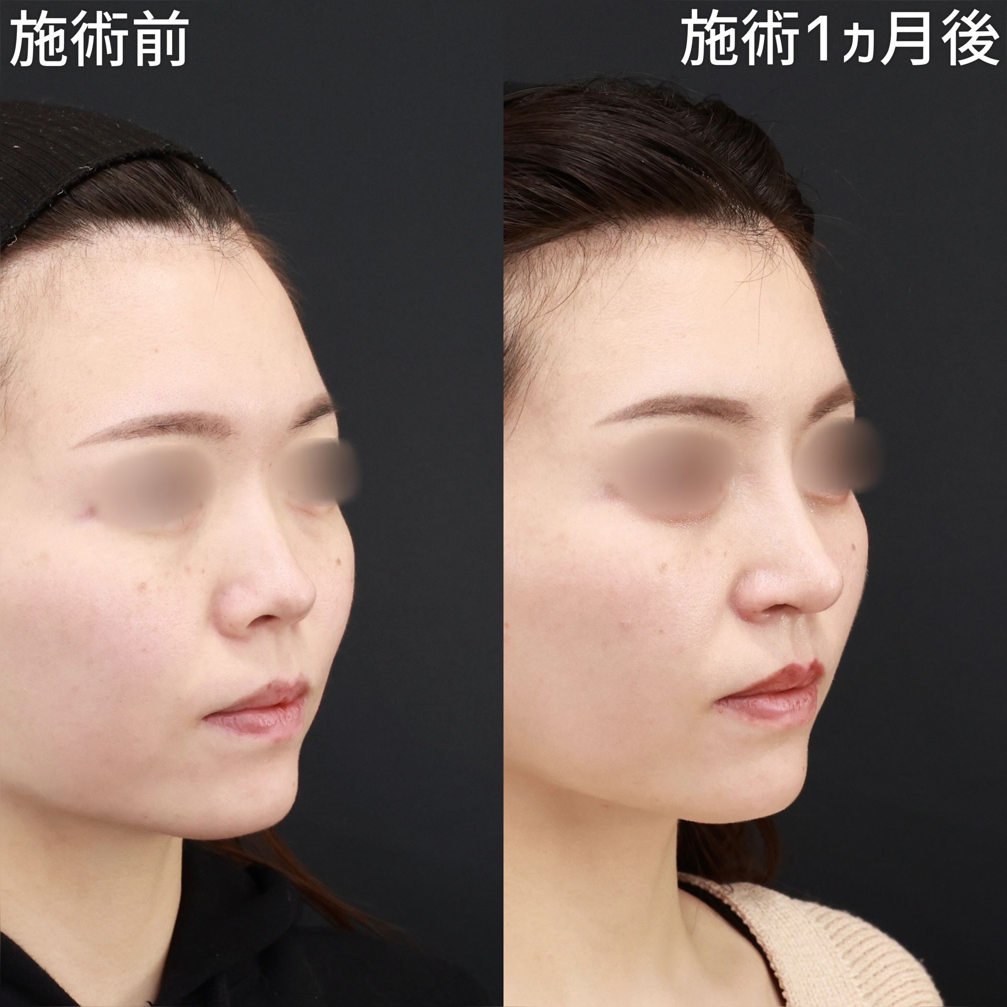 ジョールファット除去/隆鼻術（プロテーゼ・自家組織）/メーラーファット除去の症例写真 施術前後 