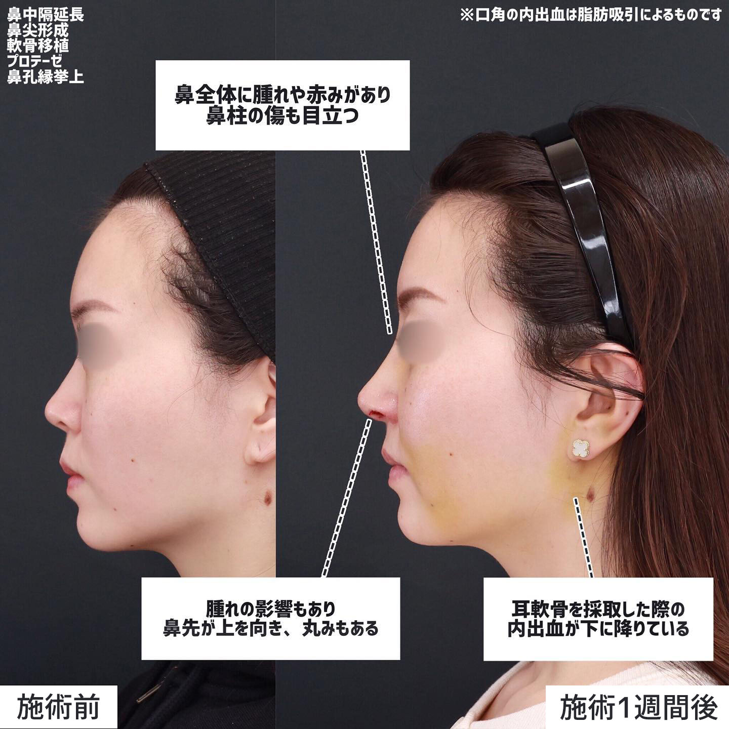 ジョールファット除去/隆鼻術（プロテーゼ・自家組織）/メーラーファット除去の症例写真 施術前後 