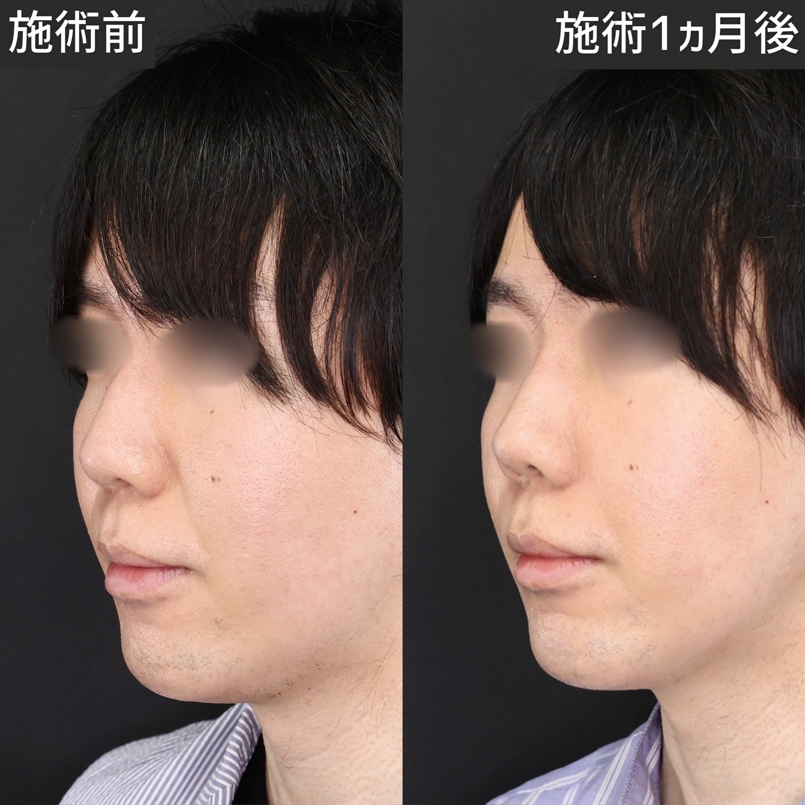 貴族手術（鼻翼基部プロテーゼ・脂肪注入・粉砕肋軟骨移植）の症例写真 施術前後 