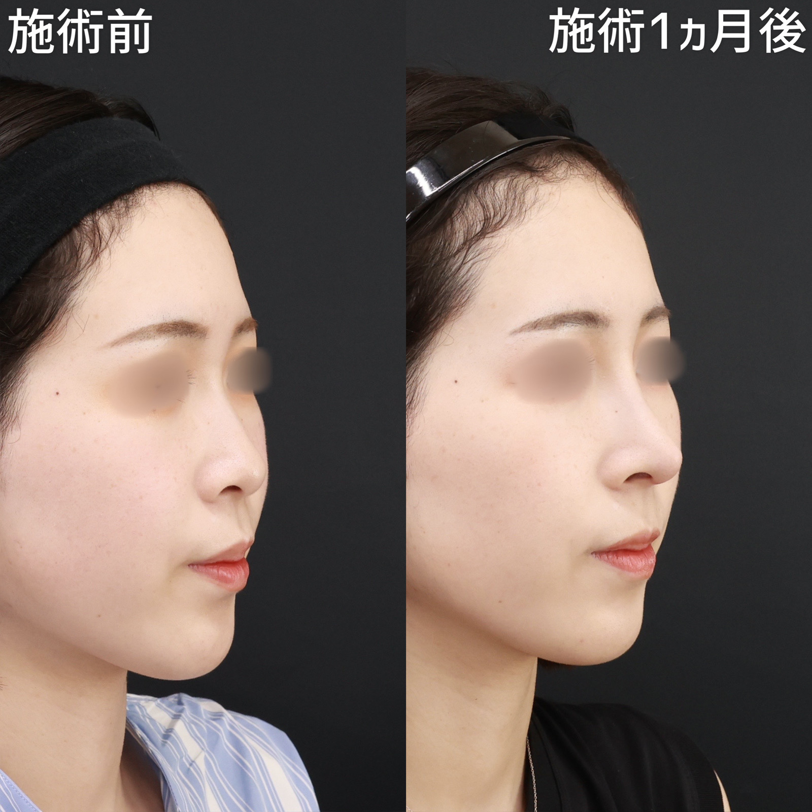 鼻中隔延長術/鼻先軟骨移植/鼻尖形成・鼻尖縮小の症例写真 施術前後 