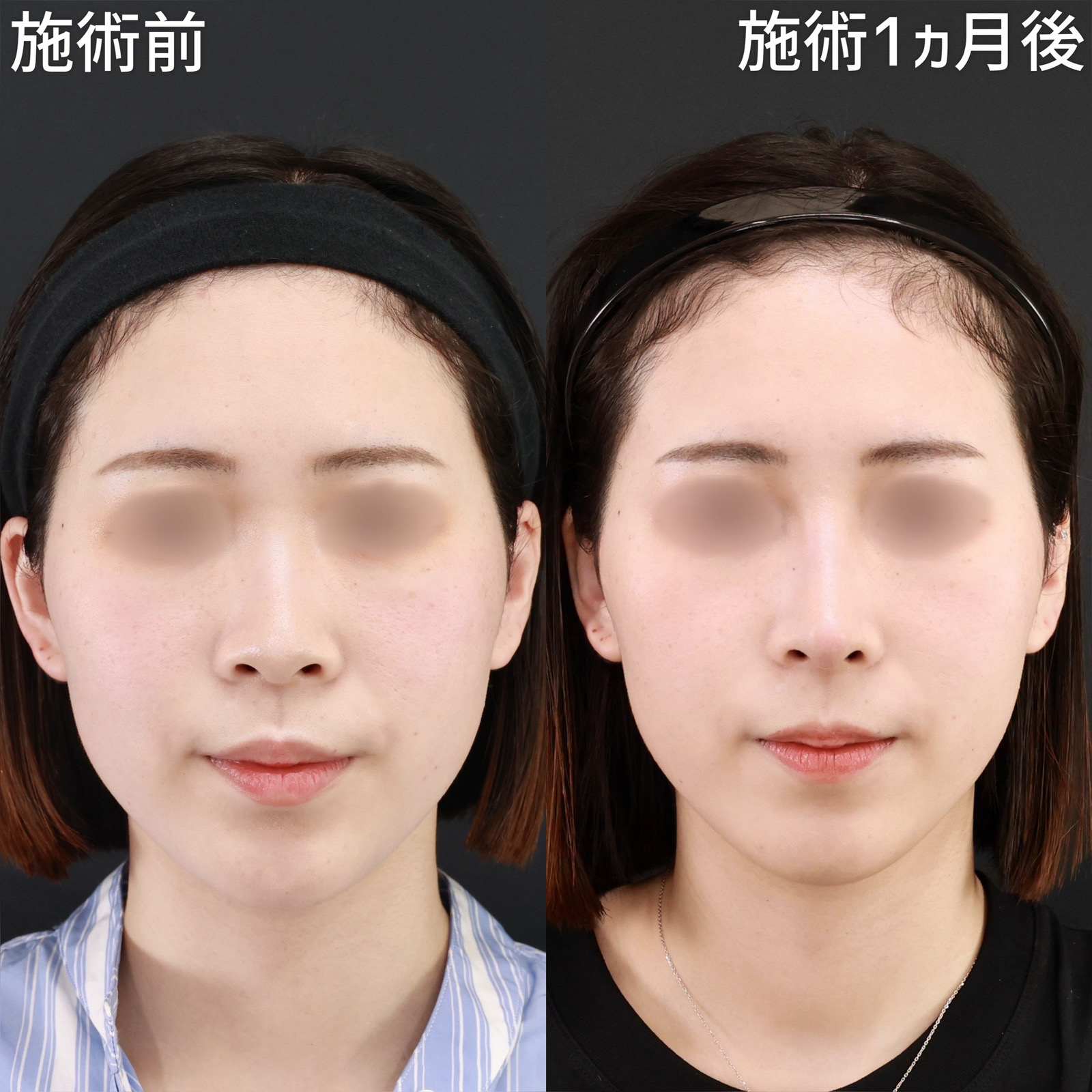 鼻中隔延長術/鼻先軟骨移植/鼻尖形成・鼻尖縮小の症例写真 施術前後 