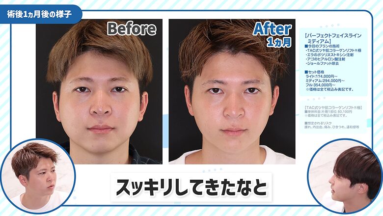 正面から見た術前と術後1カ月のビフォーアフター比較