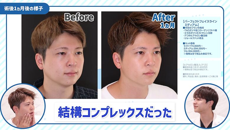斜め前から見た術前と術後1カ月のビフォーアフター比較