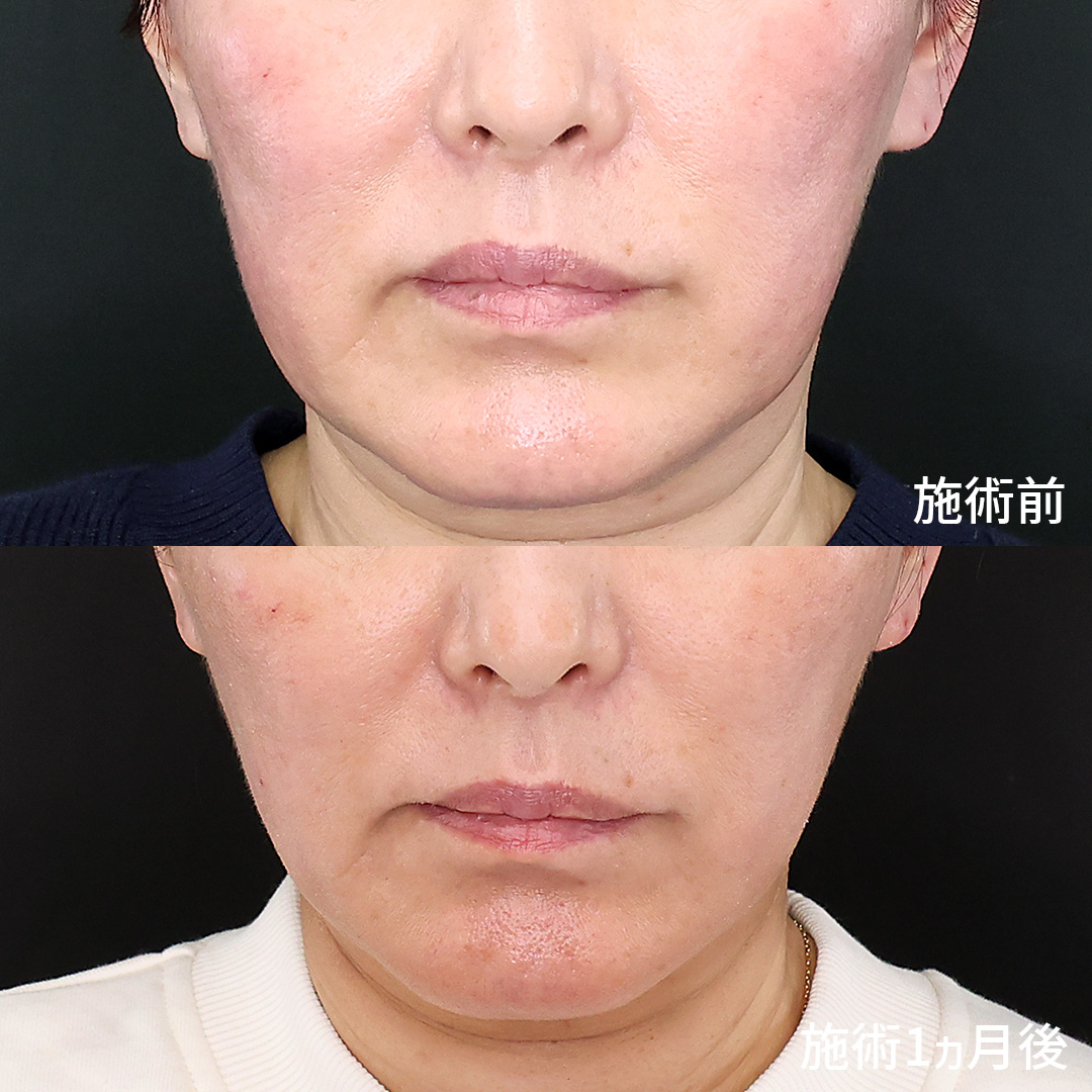 TAC式 ツヤ肌コラーゲンリフト®/ジョールファット除去/Lラインファット除去（エラ下脂肪除去）の症例写真 施術前後 