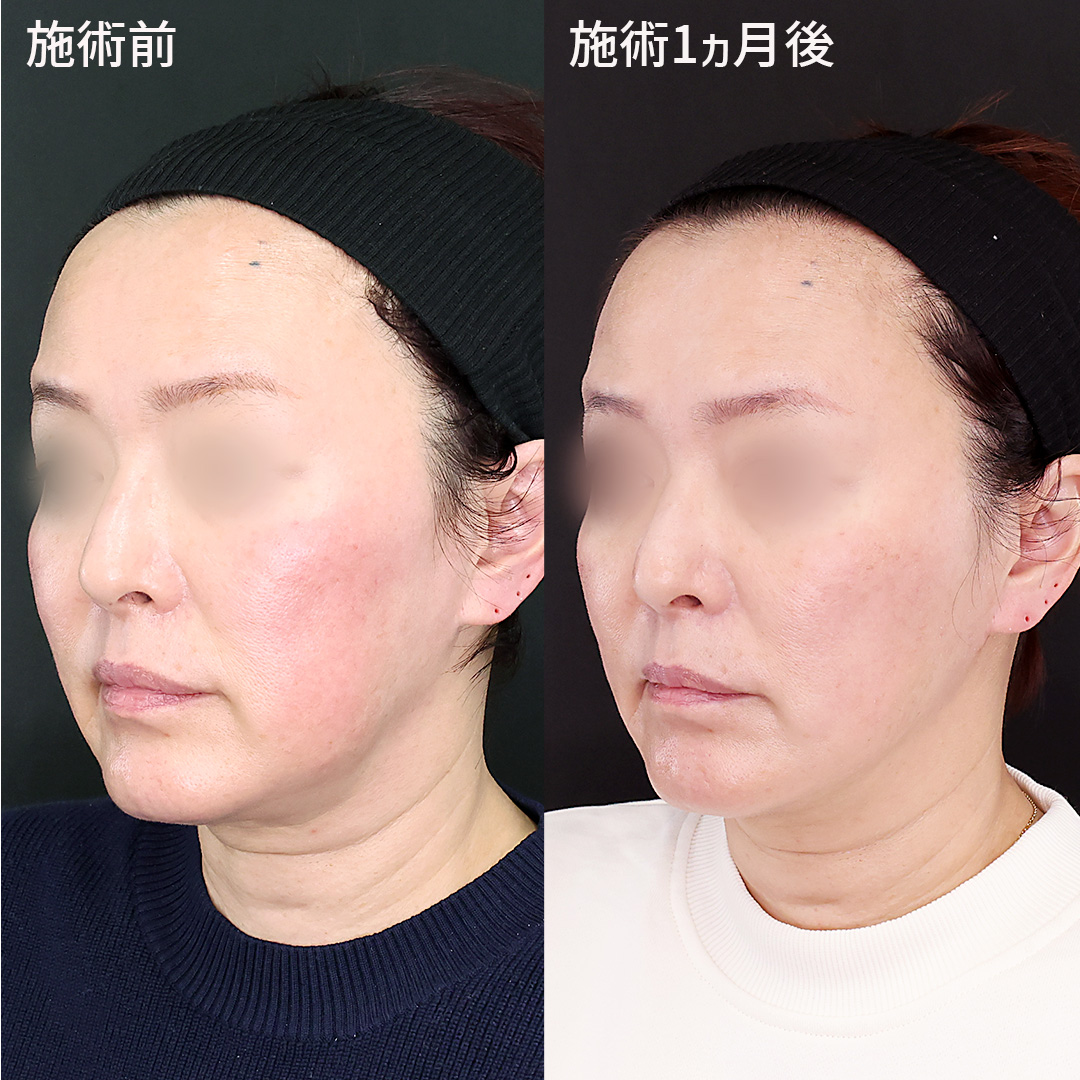 余分な脂肪を取り除き、【ツヤ肌コラーゲンリフト®極】の引き上げ効果で輪郭スッキリ！！