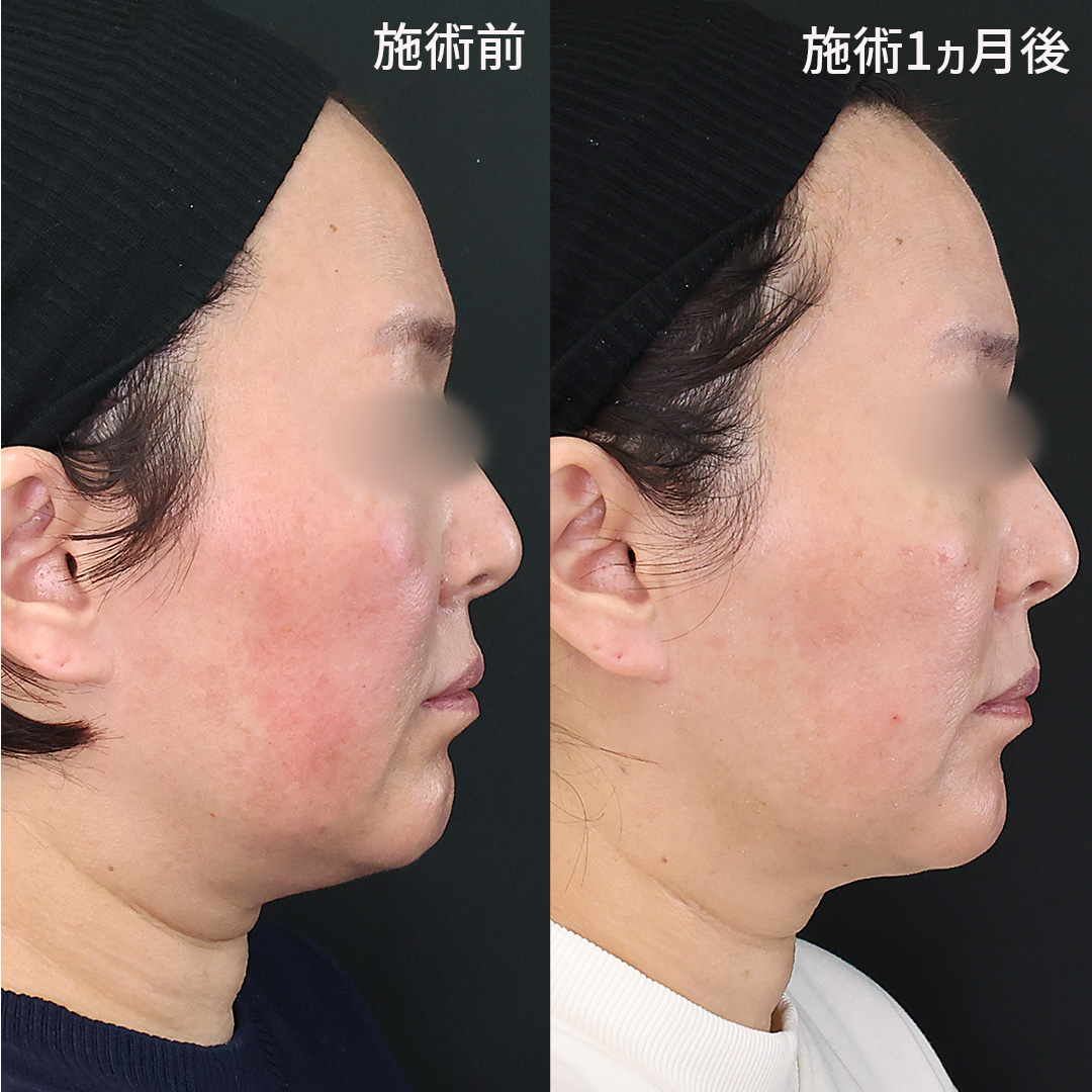 TAC式 ツヤ肌コラーゲンリフト®/ジョールファット除去/Lラインファット除去（エラ下脂肪除去）の症例写真 施術前後 