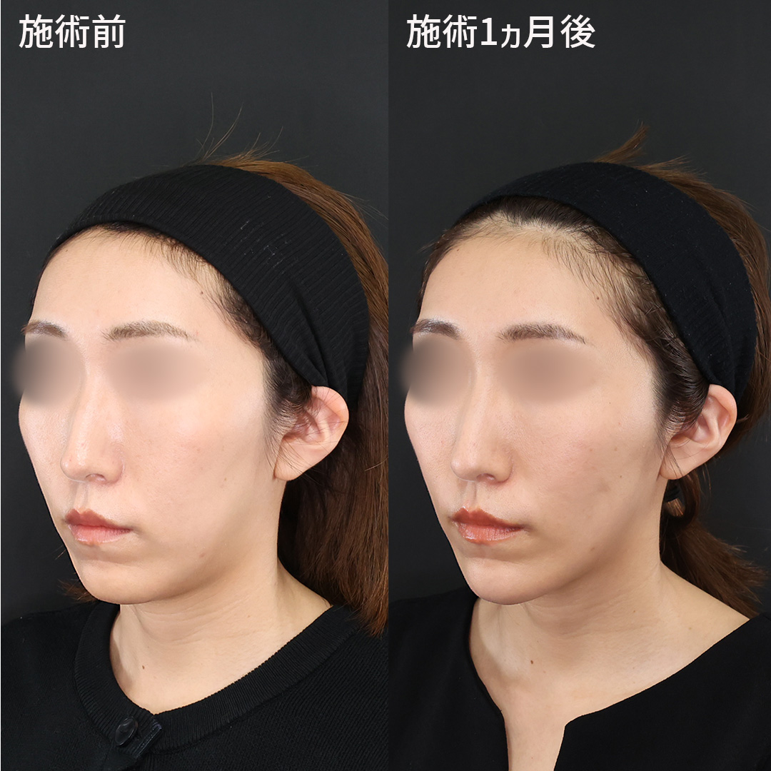 引き上げ効果で気になるアゴ下のたるみを改善。【TAC式ツヤ肌コラーゲンリフト®極】