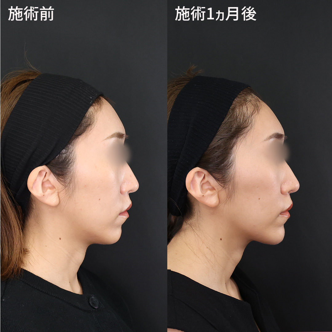 TAC式 ツヤ肌コラーゲンリフト®の症例写真 施術前後 