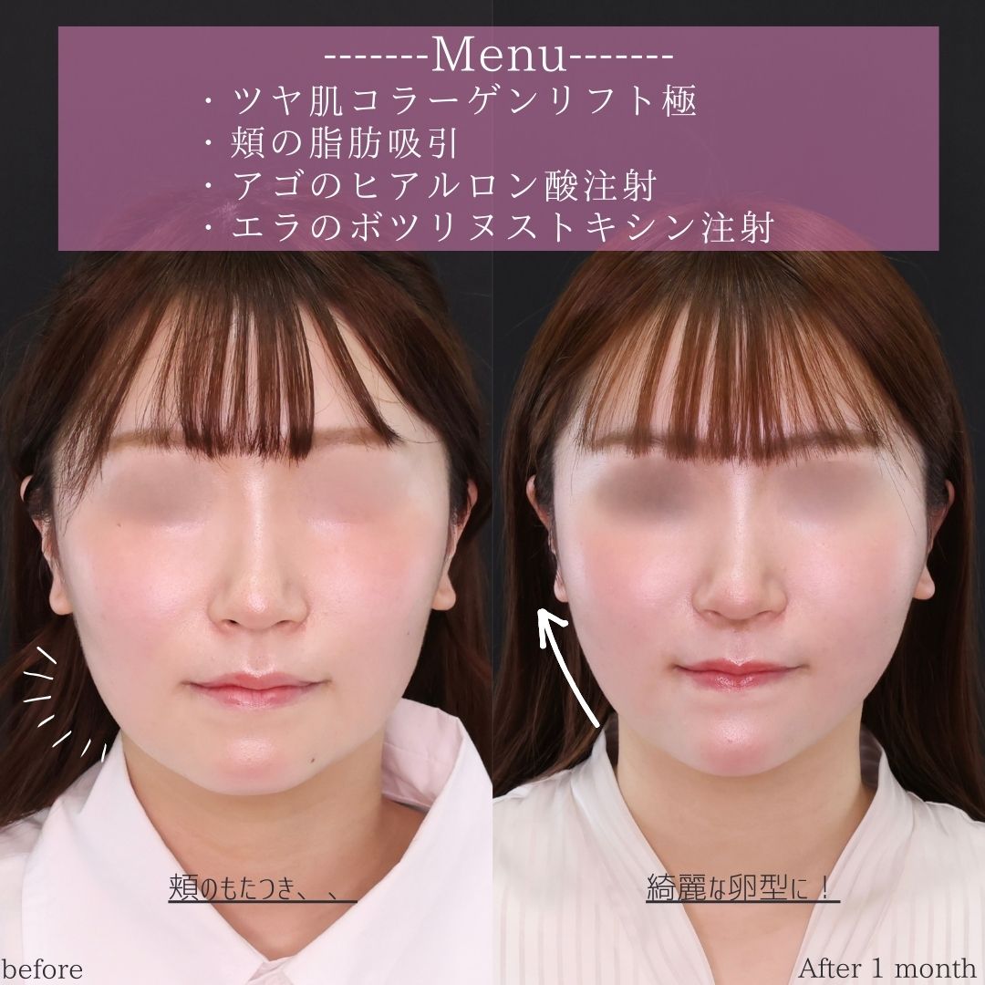 TAC式 ツヤ肌コラーゲンリフト®/顎下の脂肪吸引/顎のヒアルロン酸注射の症例写真 施術前後 