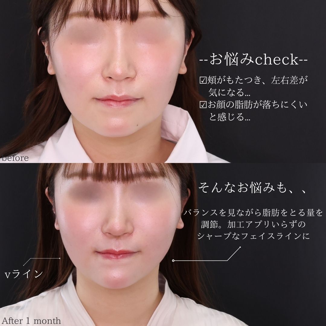 TAC式 ツヤ肌コラーゲンリフト®/顎下の脂肪吸引/顎のヒアルロン酸注射の症例写真 施術前後 