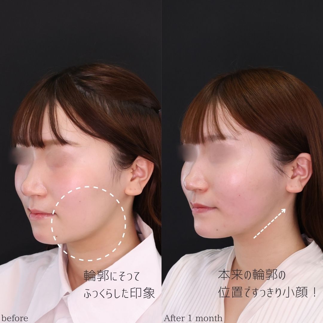 TAC式 ツヤ肌コラーゲンリフト®/顎下の脂肪吸引/顎のヒアルロン酸注射の症例写真 施術前後 