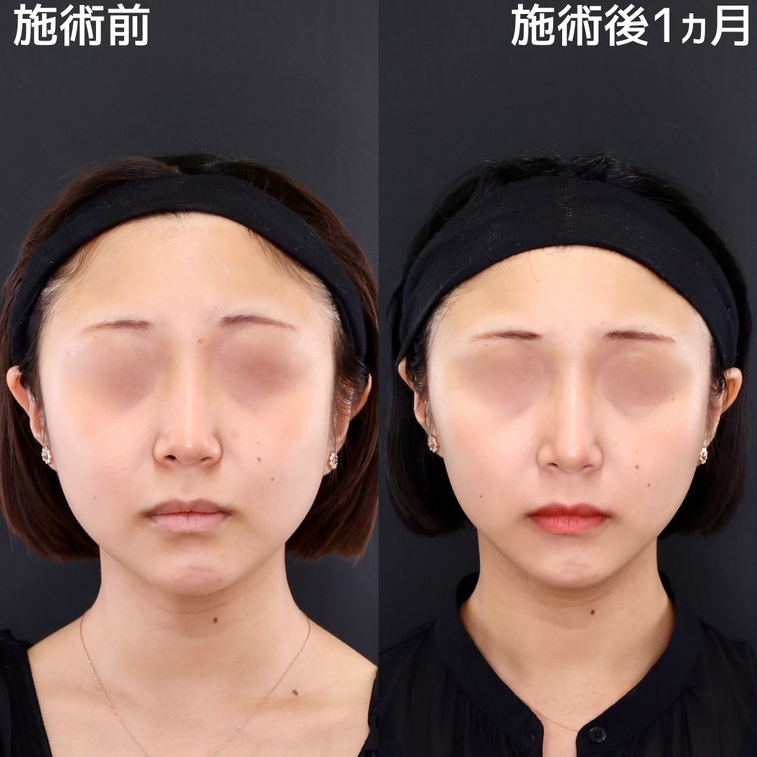 【糸リフト×ジョールファット除去】口元すっきり、垢抜けた小顔に