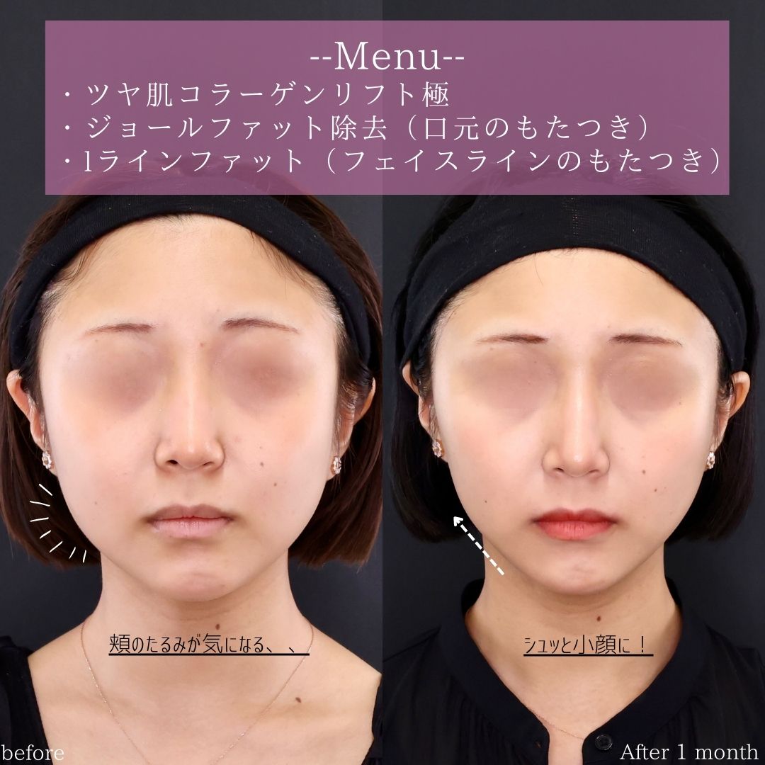 TAC式 ツヤ肌コラーゲンリフト®/ジョールファット除去/Lラインファット除去（エラ下脂肪除去）の症例写真 施術前後 