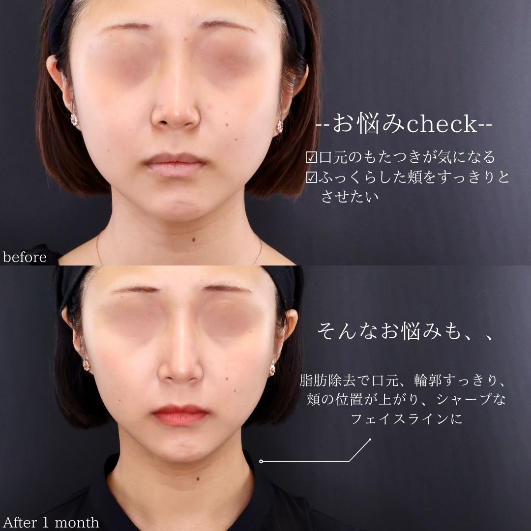 TAC式 ツヤ肌コラーゲンリフト®/ジョールファット除去/Lラインファット除去（エラ下脂肪除去）の症例写真 施術前後 