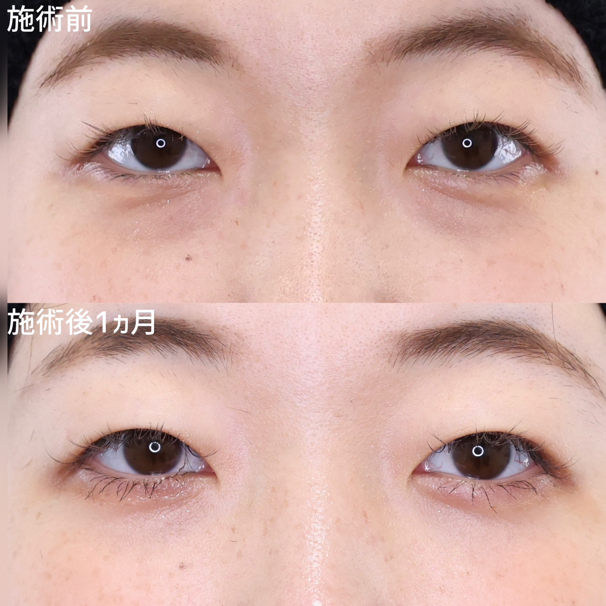 年齢より老けて見える！クマを無くして明るいお目元へ