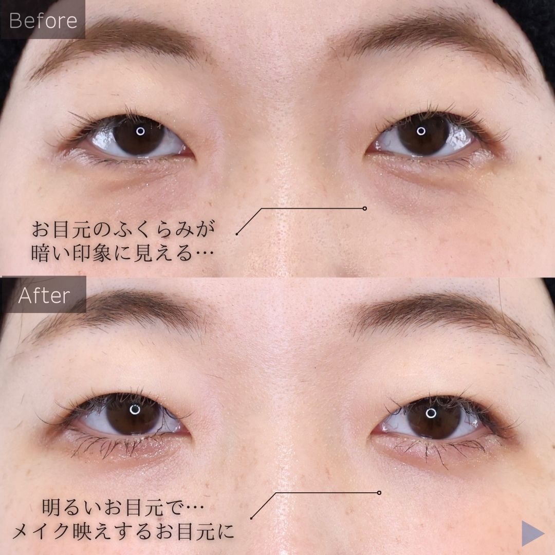 下眼瞼脱脂術（目の下のたるみ取り・目の下の脂肪ふくらみ取り）の症例写真 施術前後 