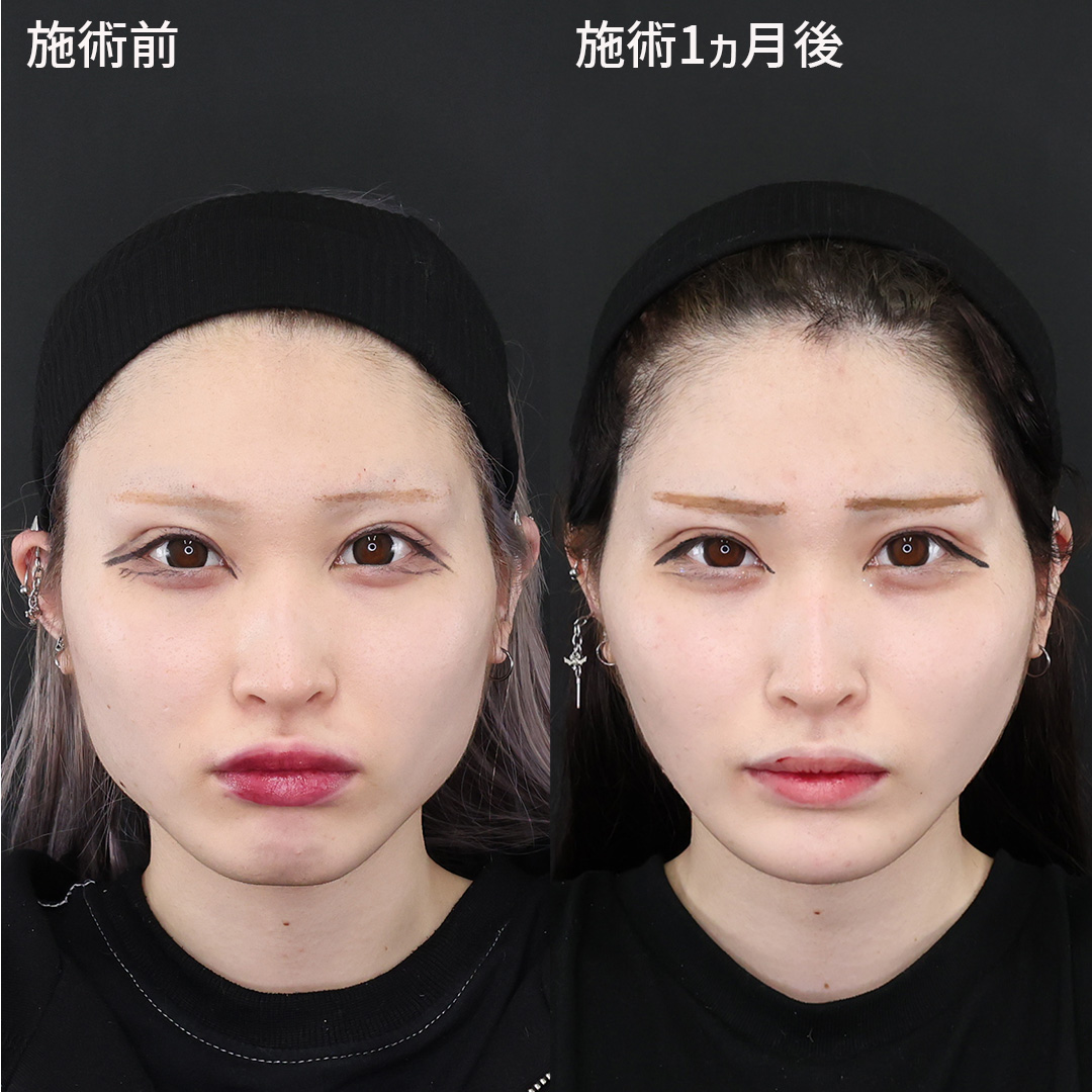 糸リフトで叶える、別人級の輪郭！