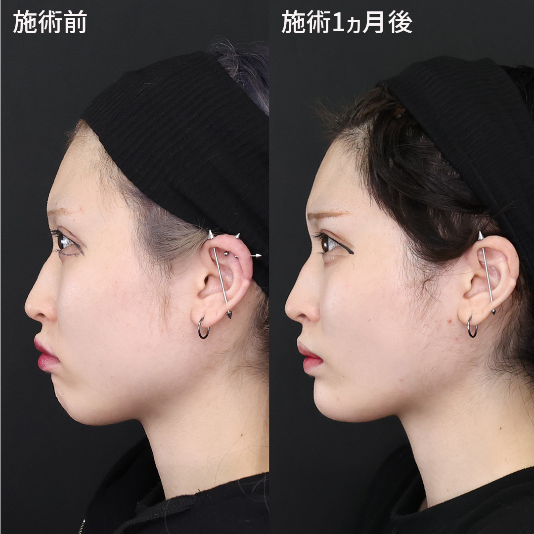 TAC式 ツヤ肌コラーゲンリフト®/エラボトックス注射/顎のヒアルロン酸注射の症例写真 施術前後 