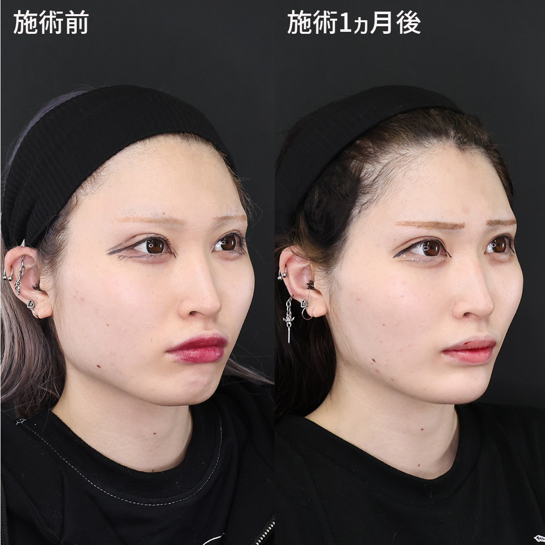 TAC式 ツヤ肌コラーゲンリフト®/エラボトックス注射/顎のヒアルロン酸注射の症例写真 施術前後 