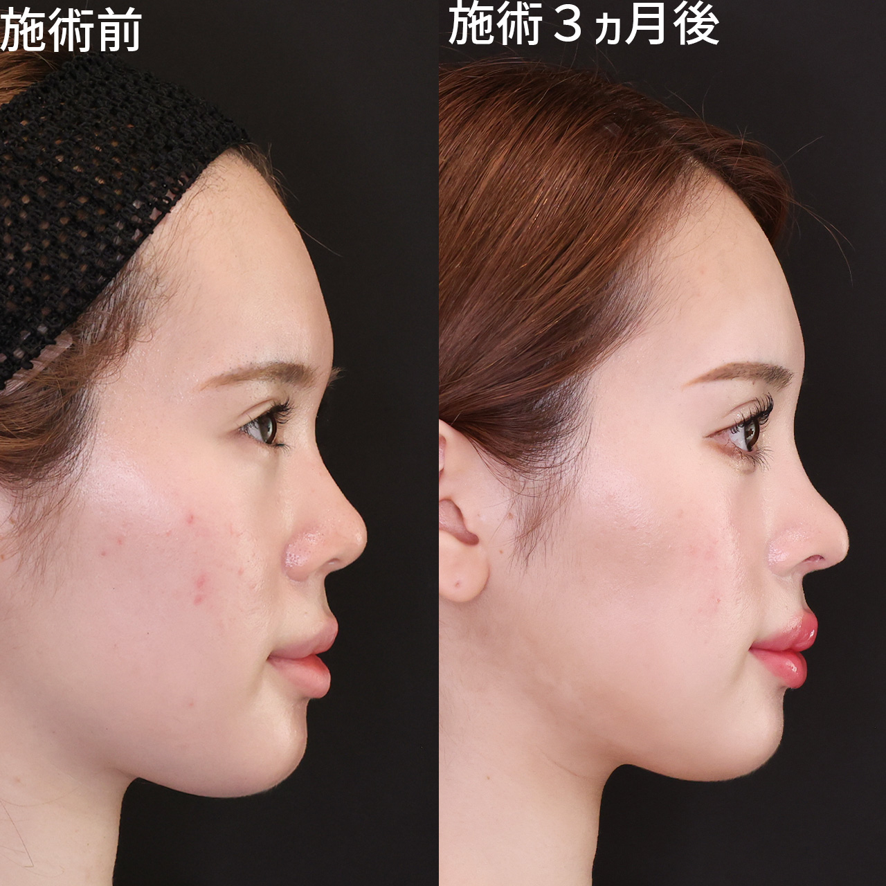 鼻中隔延長術/鼻先軟骨移植/鼻尖形成・鼻尖縮小の症例写真 施術前後 