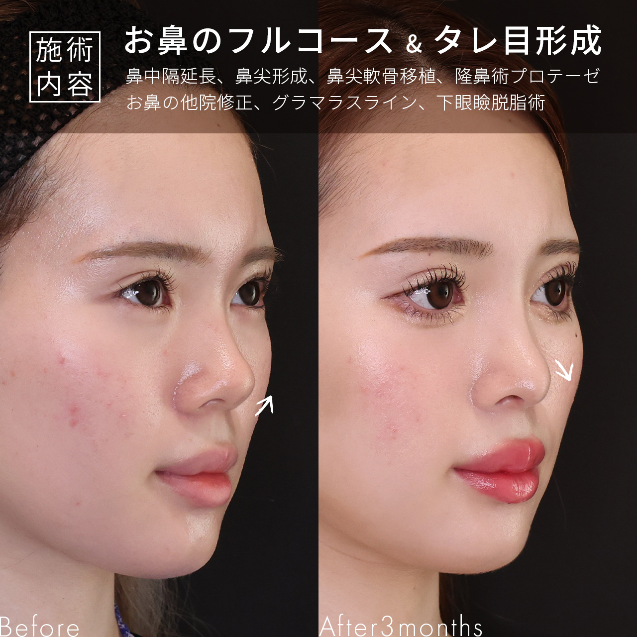 鼻中隔延長術/鼻先軟骨移植/鼻尖形成・鼻尖縮小の症例写真 施術前後 