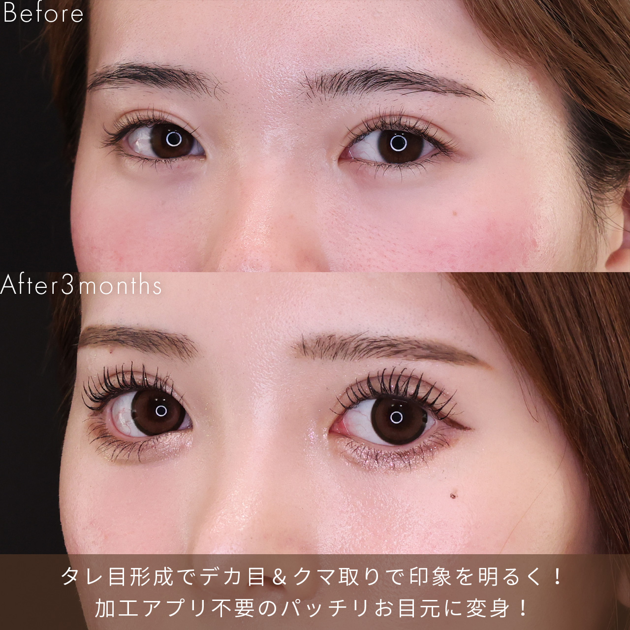 鼻中隔延長術/鼻先軟骨移植/鼻尖形成・鼻尖縮小の症例写真 施術前後 