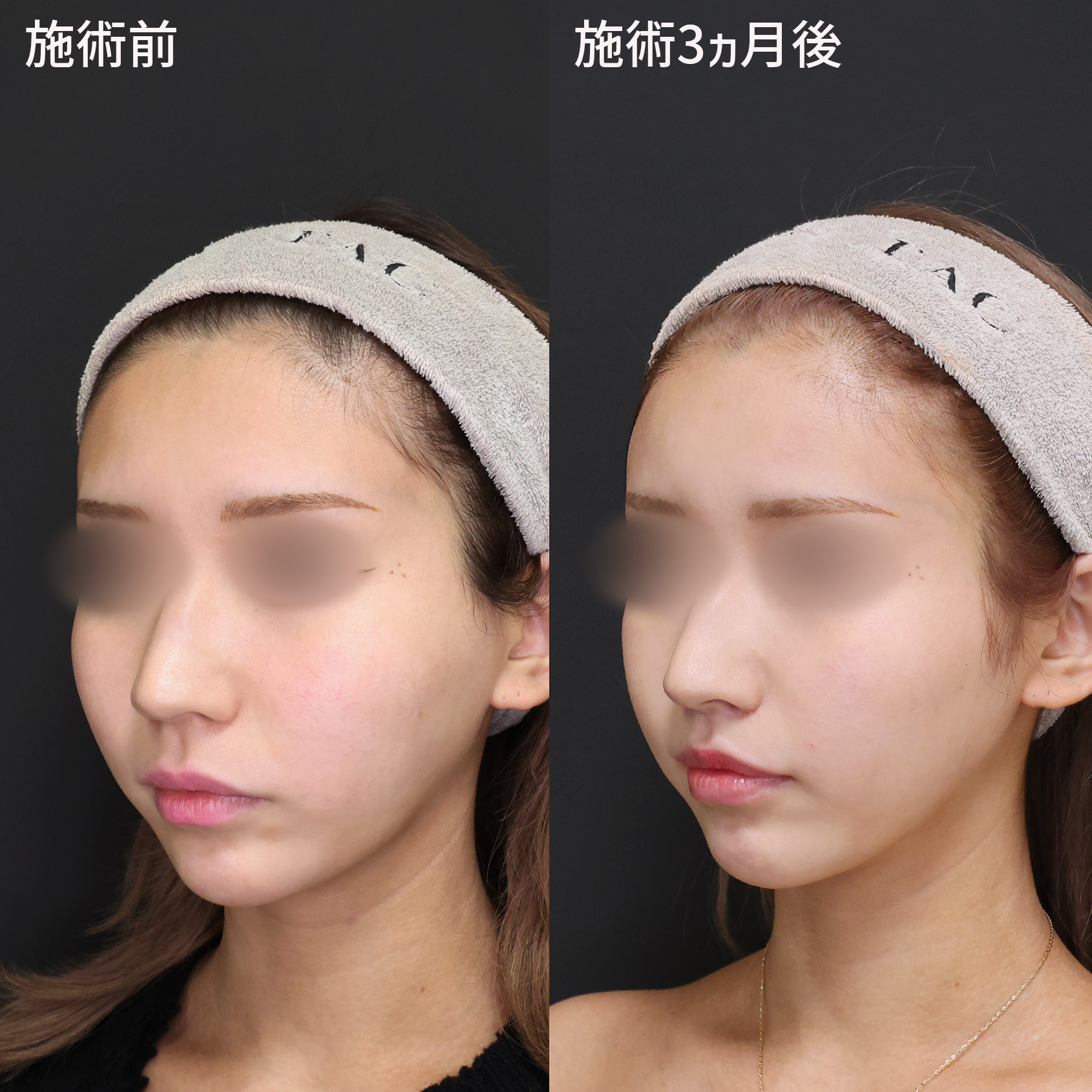 TAC式 ツヤ肌コラーゲンリフト®/口角挙上・リフト（マイクロ切開法・内側法/口内法）/人中短縮術(リップリフト)・外側人中短縮術の症例写真 施術前後 