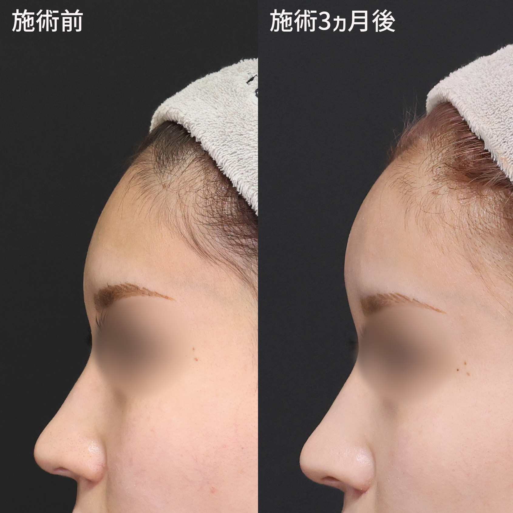 TAC式 ツヤ肌コラーゲンリフト®/口角挙上・リフト（マイクロ切開法・内側法/口内法）/人中短縮術(リップリフト)・外側人中短縮術の症例写真 施術前後 