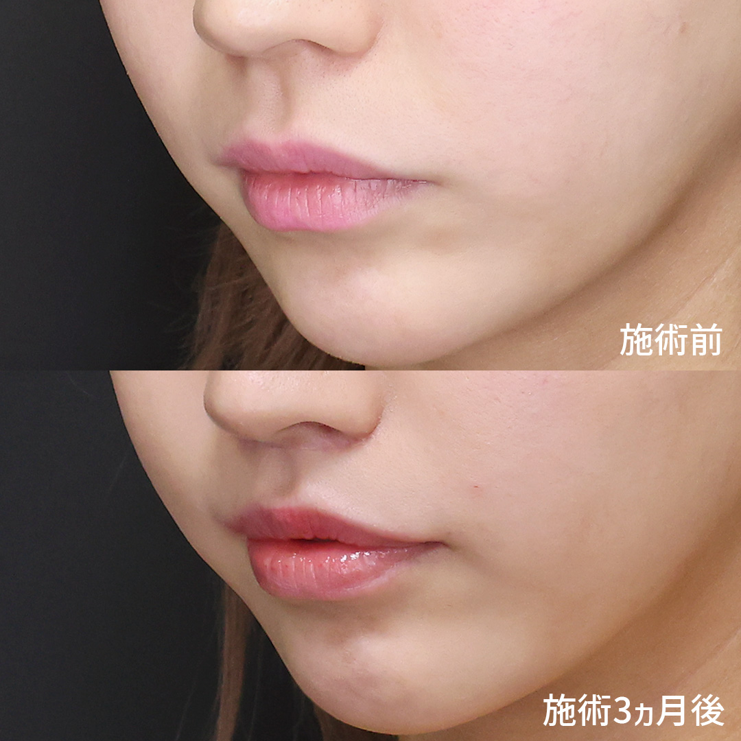 TAC式 ツヤ肌コラーゲンリフト®/口角挙上・リフト（マイクロ切開法・内側法/口内法）/人中短縮術(リップリフト)・外側人中短縮術の症例写真 施術前後 