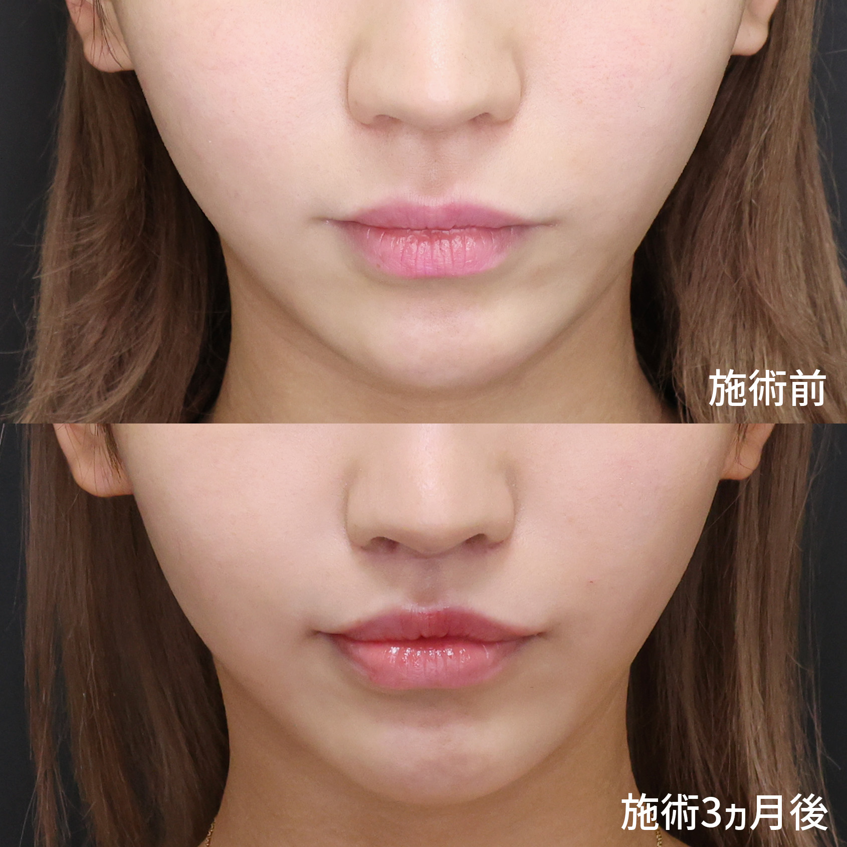 TAC式 ツヤ肌コラーゲンリフト®/口角挙上・リフト（マイクロ切開法・内側法/口内法）/人中短縮術(リップリフト)・外側人中短縮術の症例写真 施術前後 