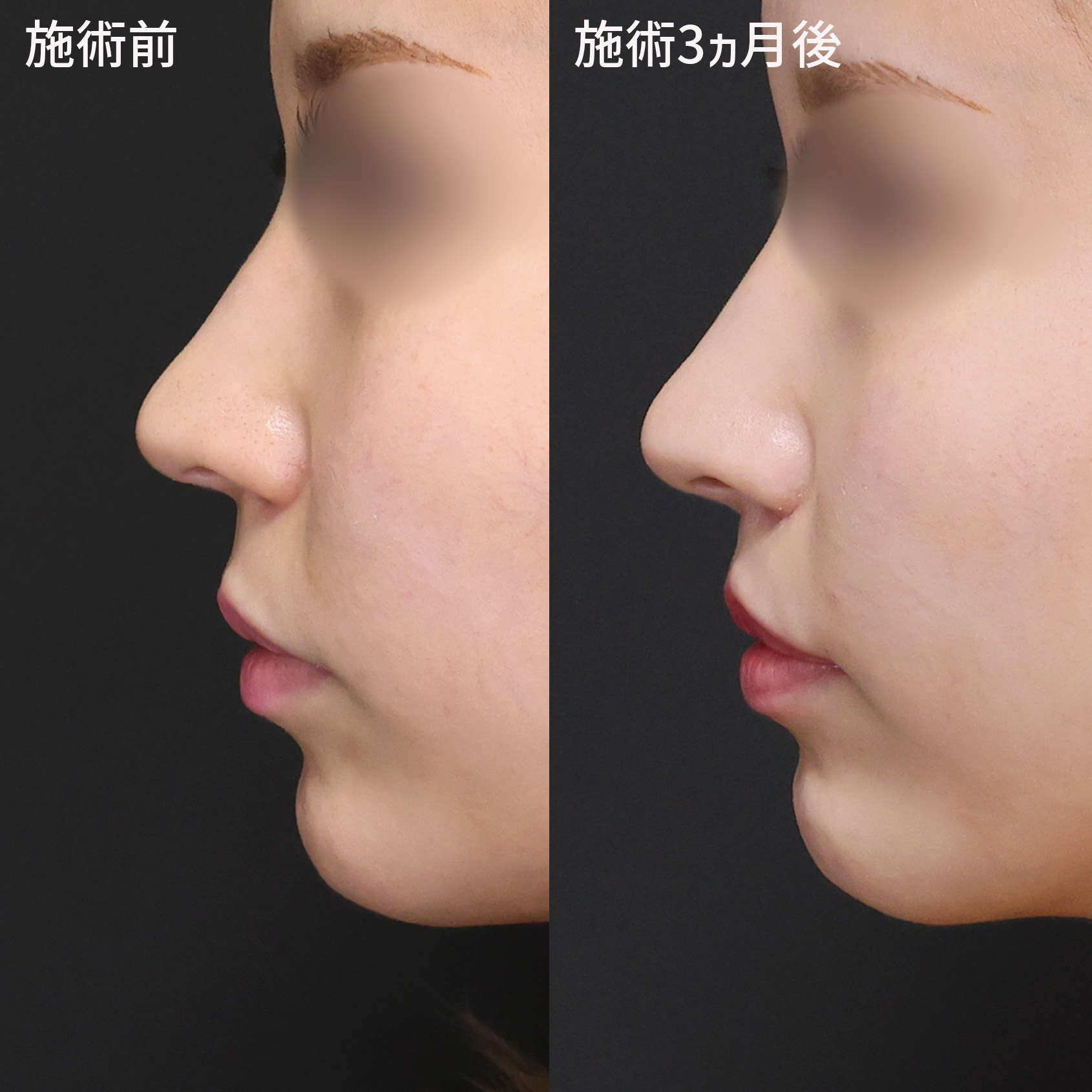 TAC式 ツヤ肌コラーゲンリフト®/口角挙上・リフト（マイクロ切開法・内側法/口内法）/人中短縮術(リップリフト)・外側人中短縮術の症例写真 施術前後 