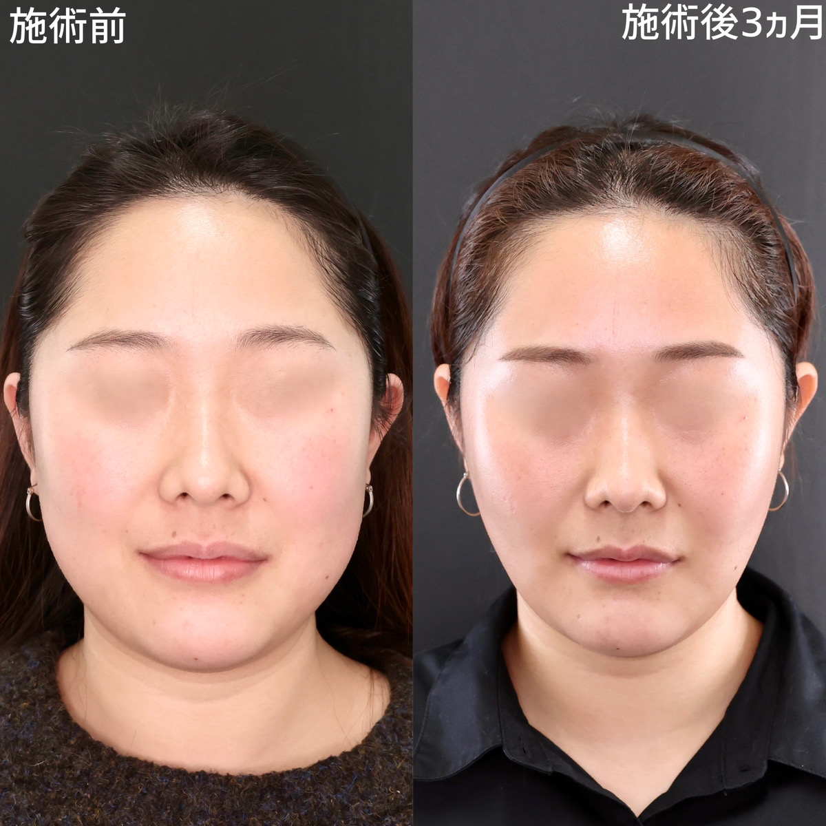 【糸リフト×脂肪吸引】落ちにくいお顔の脂肪もここまで小顔に！