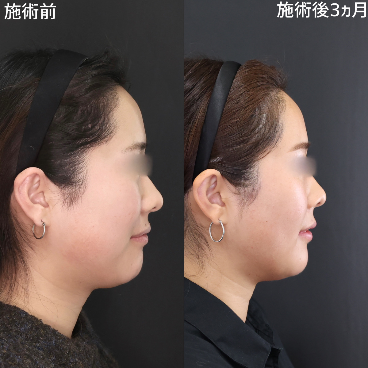 バッカルファット除去/Lラインファット除去（エラ下脂肪除去）/ジョールファット除去の症例写真 施術前後 