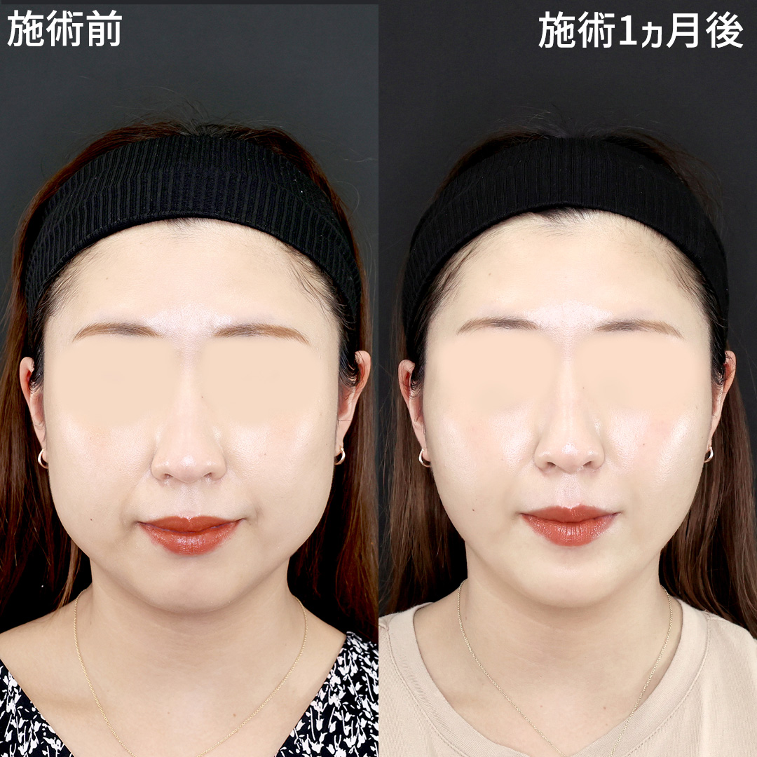 脂肪溶解注射と糸リフトでたるみのある丸顔からバランスの良い美しい輪郭に