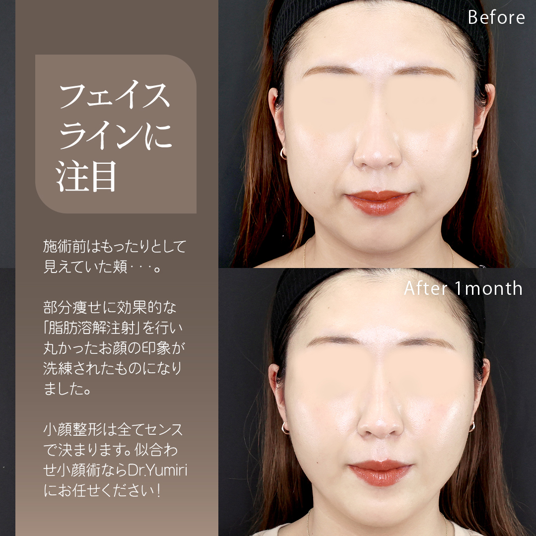 TAC式 ツヤ肌コラーゲンリフト®/脂肪溶解注射/顎のヒアルロン酸注射の症例写真 施術前後