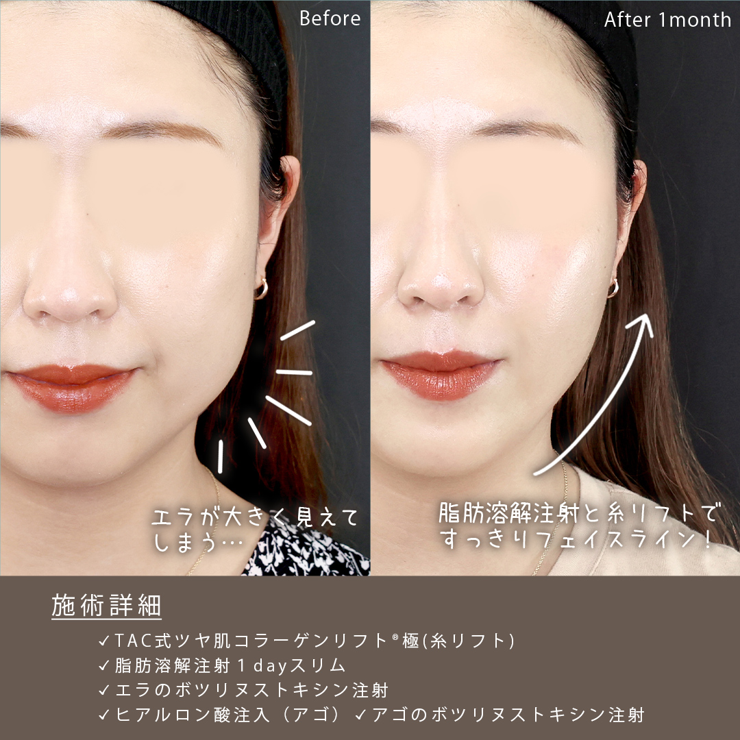TAC式 ツヤ肌コラーゲンリフト®/脂肪溶解注射/顎のヒアルロン酸注射の症例写真 施術前後