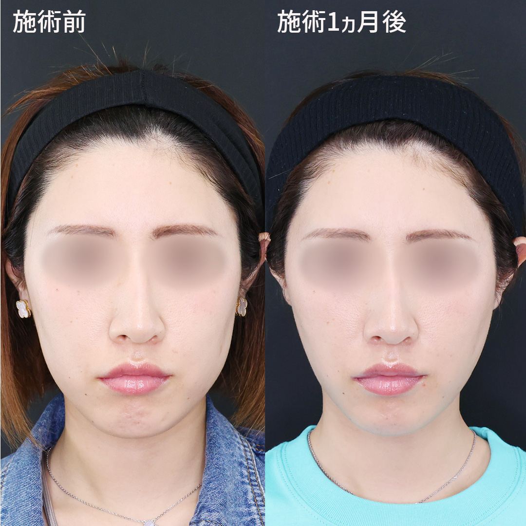 たるんだ肌を引き締め理想の輪郭を手に入れる。仕上がりも自然な糸リフト。