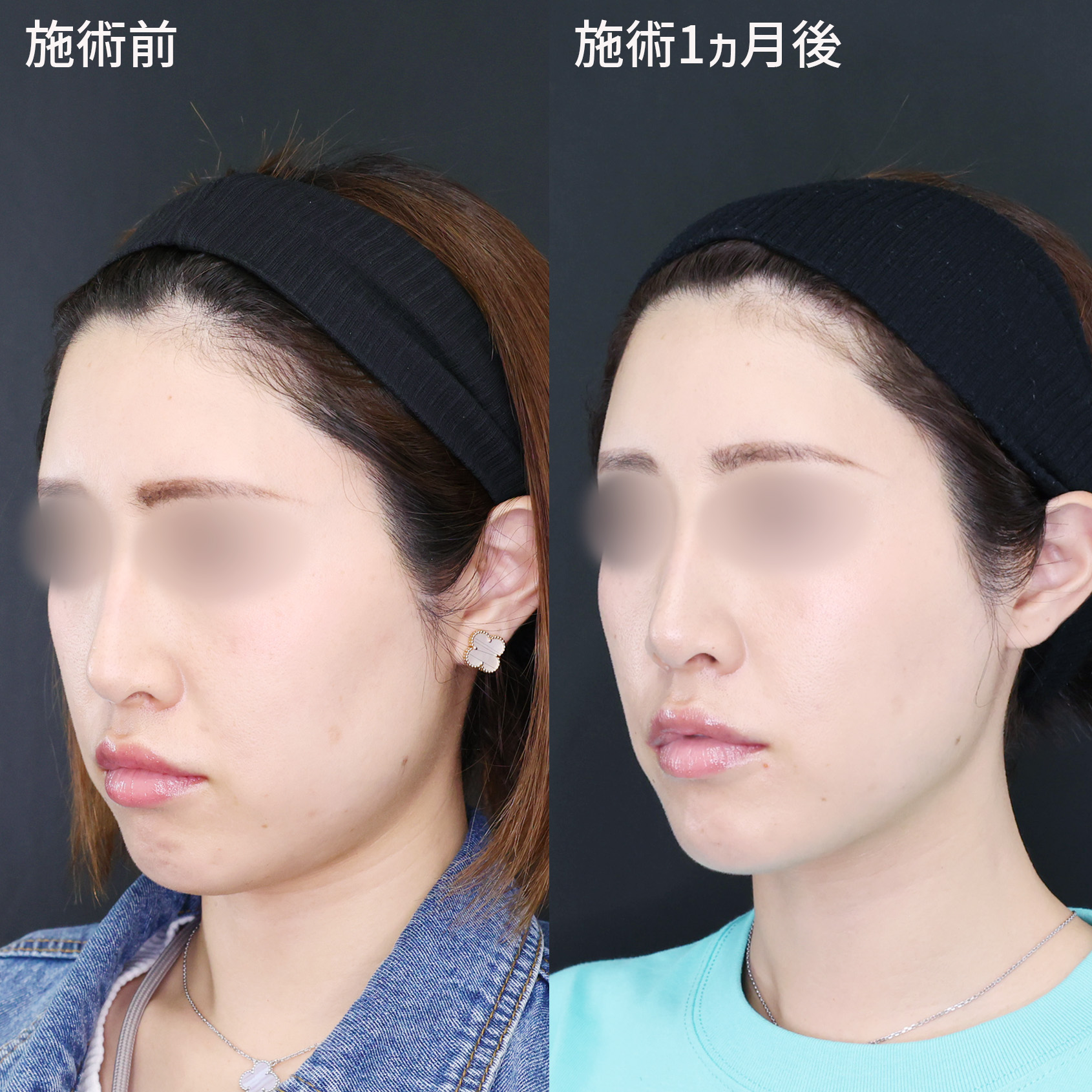 TAC式 ツヤ肌コラーゲンリフト®/TAC式 ショッピングリフト/エラボトックス注射の症例写真 施術前後 