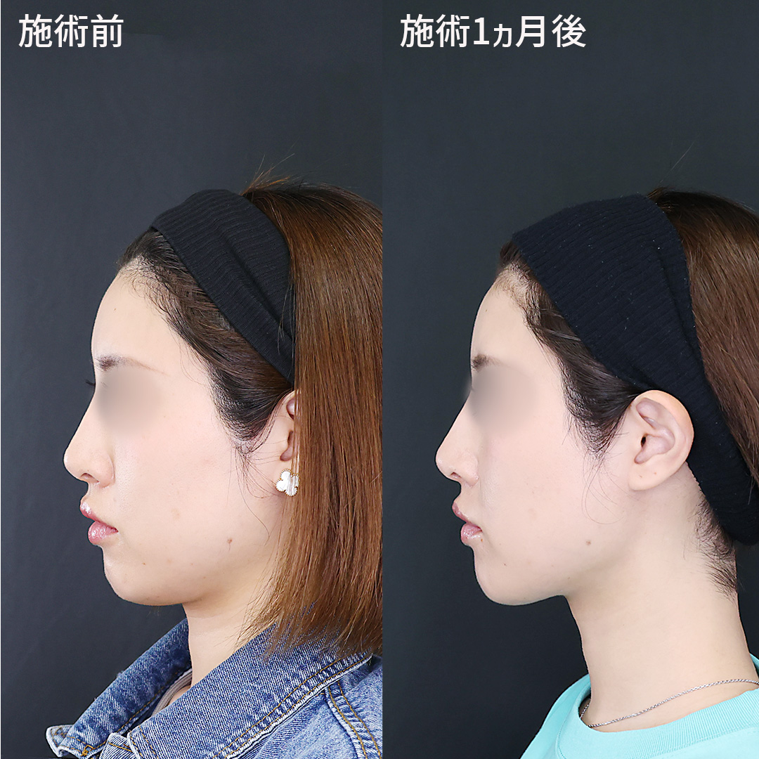 TAC式 ツヤ肌コラーゲンリフト®/TAC式 ショッピングリフト/エラボトックス注射の症例写真 施術前後 