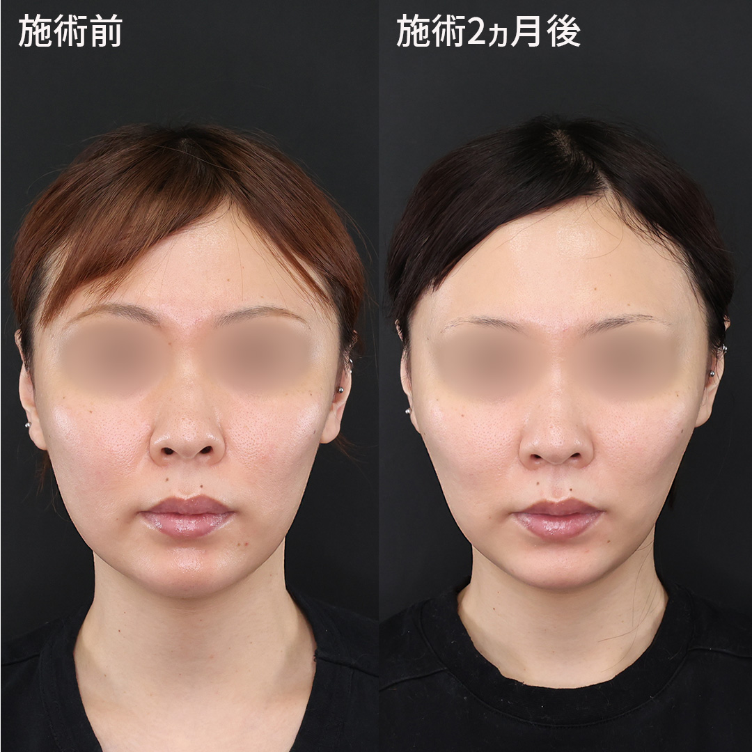 糸による引き上げ効果でここまで変わる！TAクリニックの【ツヤ肌コラーゲンリフト®極】