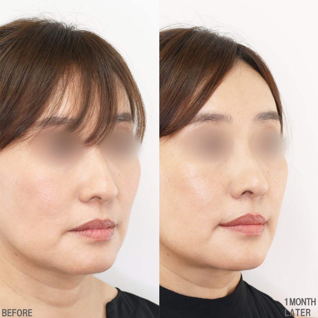 口角挙上・リフト（マイクロ切開法・内側法/口内法）の症例写真 施術前後 