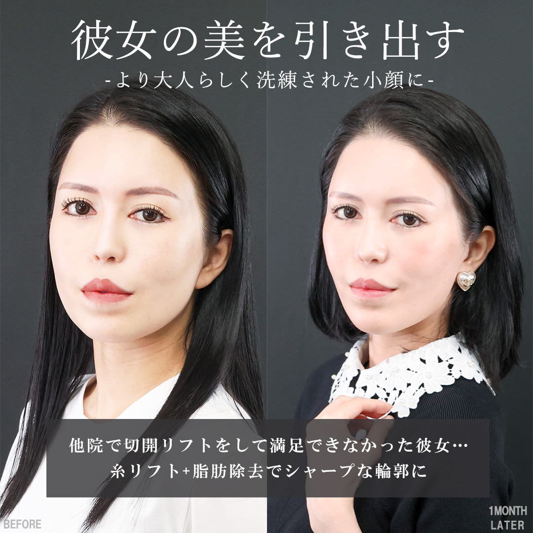 TAC式 ツヤ肌コラーゲンリフト®/TAC式 ショッピングリフト/ジョールファット除去の症例写真 施術前後