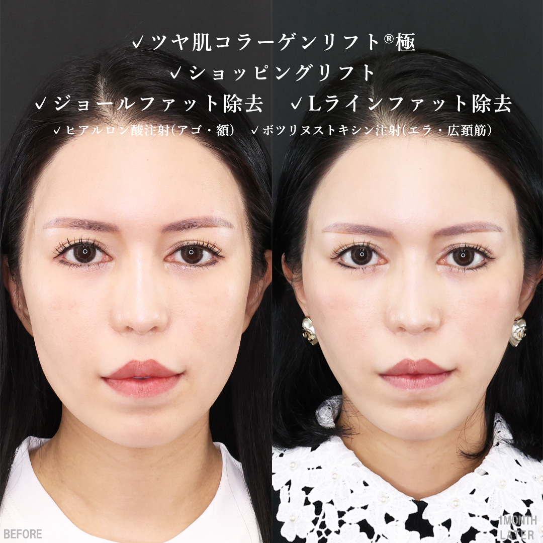 TAC式 ツヤ肌コラーゲンリフト®/TAC式 ショッピングリフト/ジョールファット除去の症例写真 施術前後