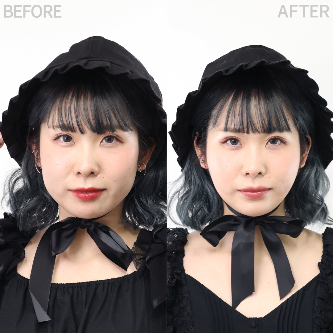 TAC式 ツヤ肌コラーゲンリフト®/ジョールファット除去/バッカルファット除去の症例写真 施術前後 