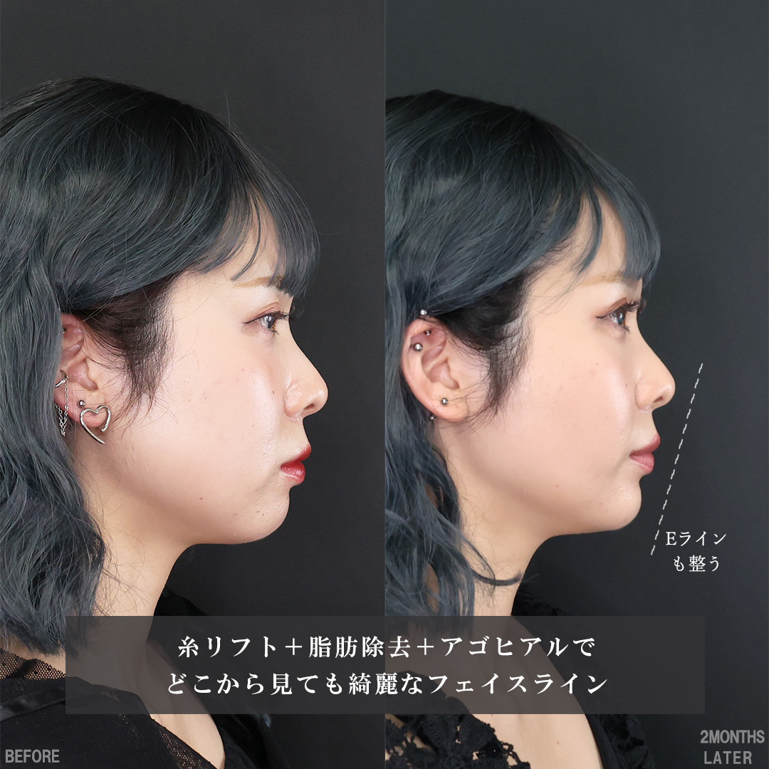 TAC式 ツヤ肌コラーゲンリフト®/ジョールファット除去/バッカルファット除去の症例写真 施術前後 