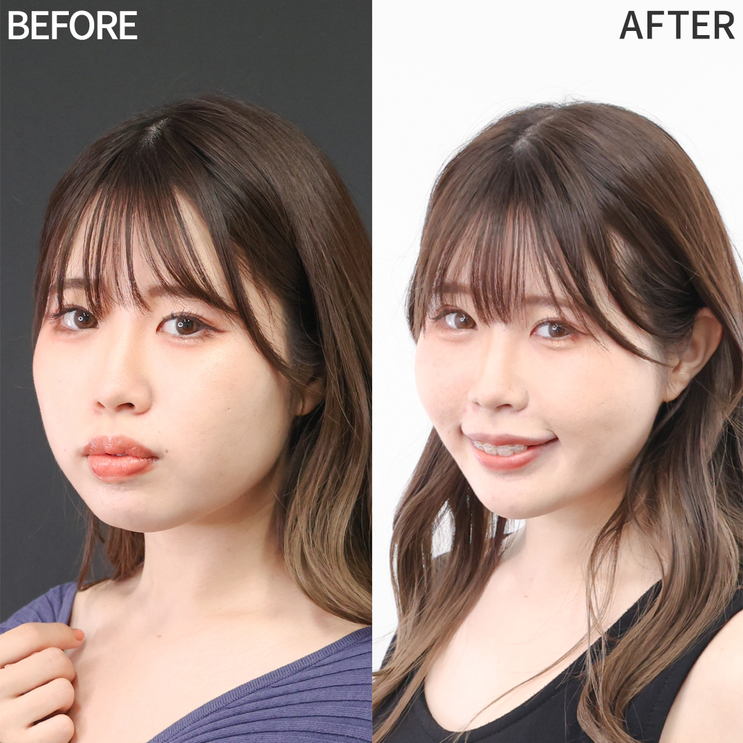 TAC式 ツヤ肌コラーゲンリフト®/バッカルファット除去/Lラインファット除去(エラ下脂肪除去)の症例写真 施術前後